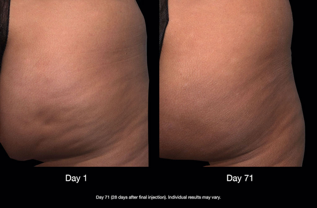 How Can I Reduce The Appearance Of Cellulite?