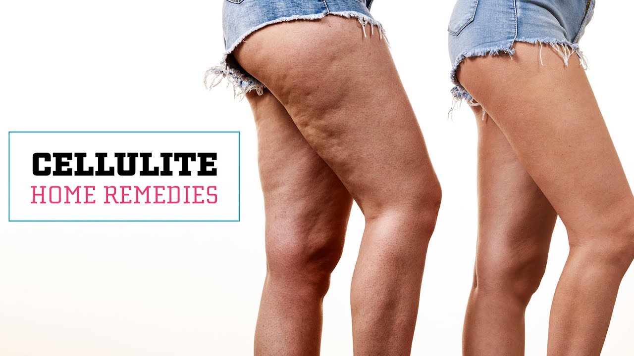 How Can I Reduce The Appearance Of Cellulite?