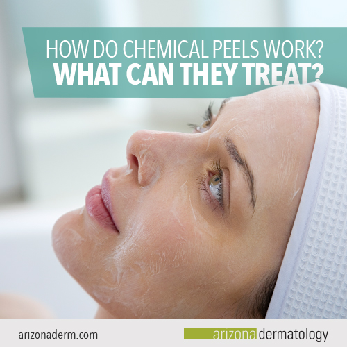 How Does A Chemical Peel Work?