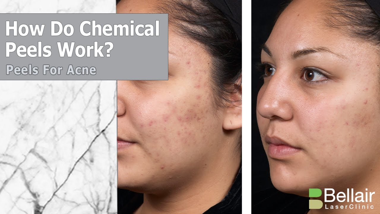 How Does A Chemical Peel Work?