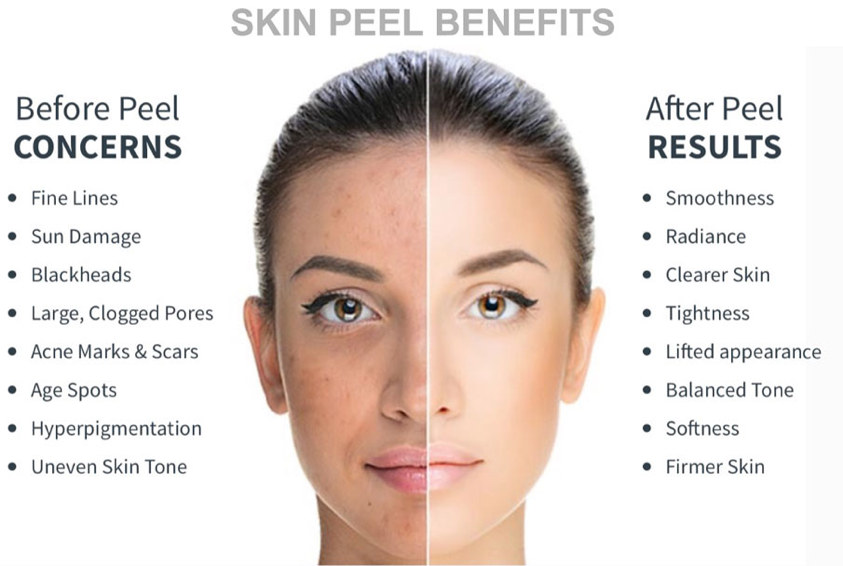 How Does A Chemical Peel Work?