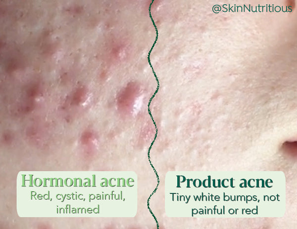 How Do I Know If A Skincare Product Is non-comedogenic?