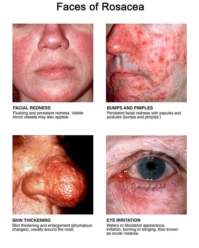 What Is Rosacea And How Is It Treated?