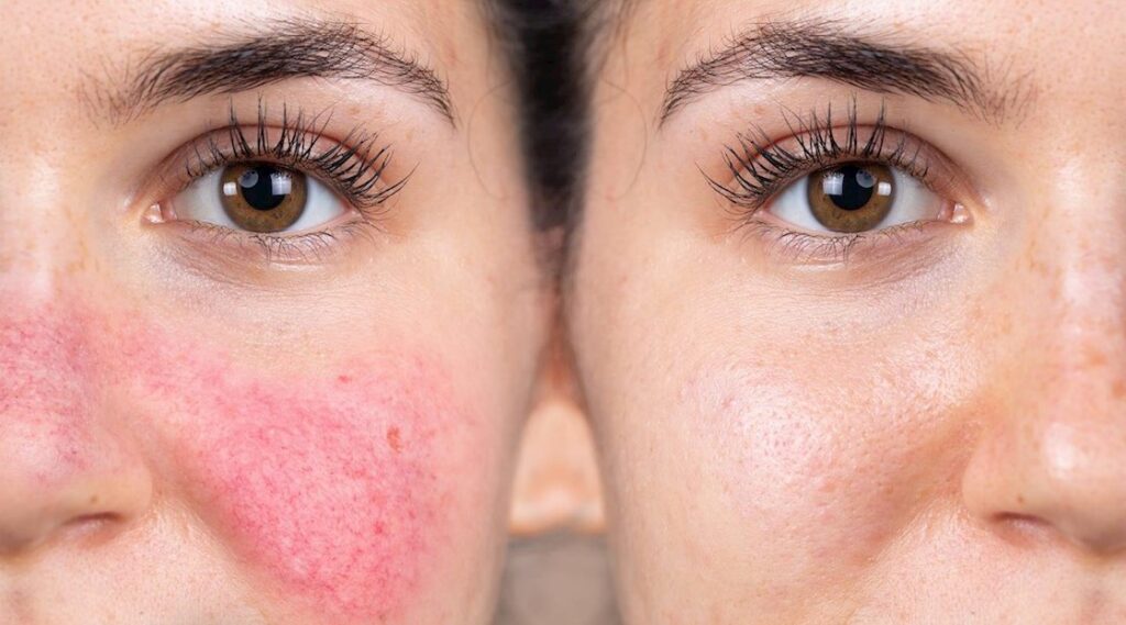 what is rosacea and how is it treated 3
